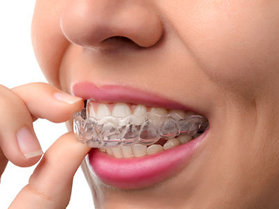 The image shows a person with an overbite, wearing clear braces and holding them in their hand while looking directly at the camera.
