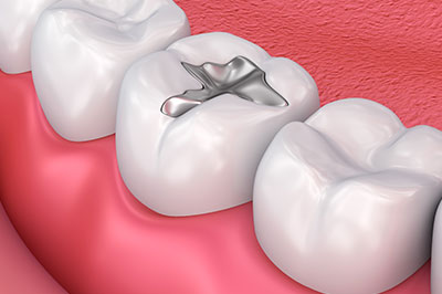 The image shows a close-up of a dental implant inserted into a tooth with a pink gum background, highlighting the metallic implant.