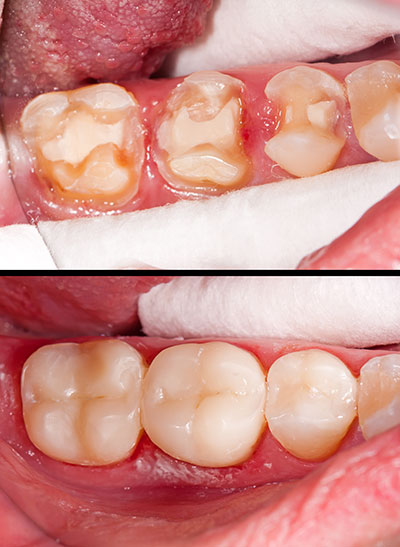 The image shows a close-up of a person s mouth with teeth in various stages of decay and wear, some missing, others discolored, against a background that appears to be a medical setting.