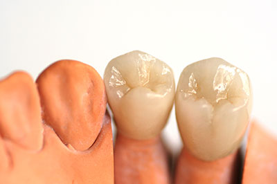 The image shows a set of dental implants and crowns, with one piece already attached to the jaw.