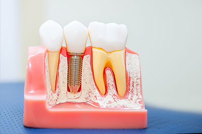 The image shows a model of human teeth with artificial gums, featuring dental implants and a single tooth with an exposed root.