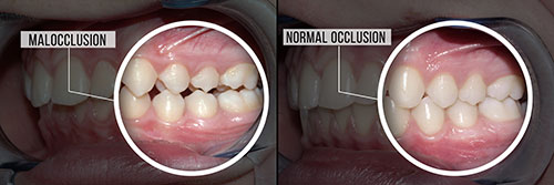 The image shows a side-by-side comparison of a person s mouth with teeth in normal condition on the left and an altered, malformed condition on the right.