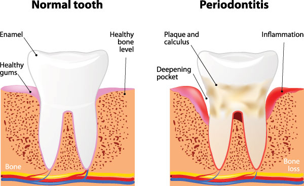 The image is a medical illustration showing the stages of tooth decay from normal to periodontitis, highlighting the progression and potential consequences of poor oral hygiene.