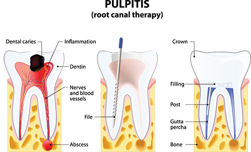 The image displays a diagrammatic illustration of the pulpitis stage in dental caries, showing the affected tooth with a visible cavity and inflammation, along with annotations indicating the presence of bacteria, inflammation, and the process of dentin breakdown.