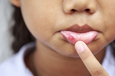 The image shows a close-up of a young child s face with a finger pointing to their lips, which appear to have a rash or irritation.