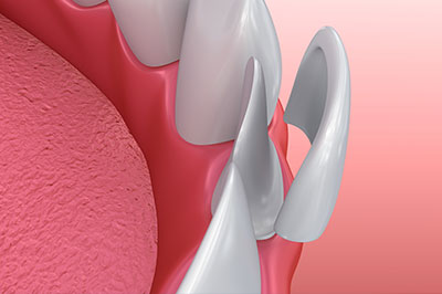 The image shows a close-up of a dental implant with a pink gum background, highlighting the screw and surrounding tissue.