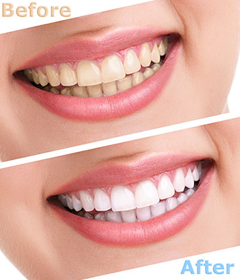 The image shows a before-and-after comparison of teeth whitening, with the left side showing discolored teeth and the right side displaying brightly white teeth.