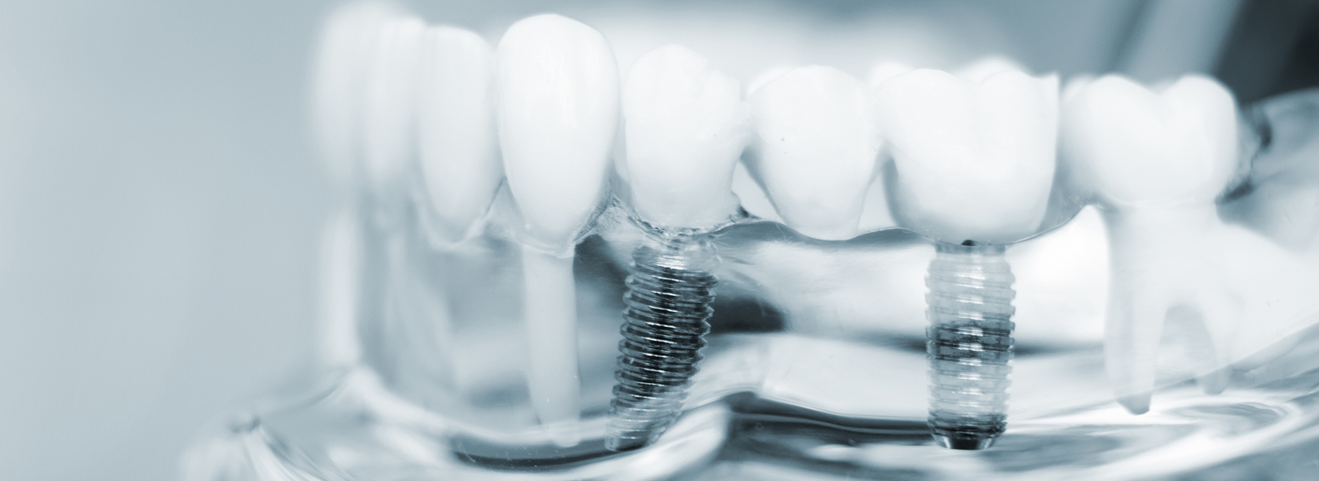 Brian J. Rosen, DDS | Digital Radiography, Extractions and Implant Dentistry
