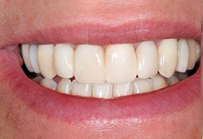 Smiling mouth showing teeth with braces, set against a neutral background.