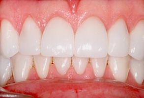 Brian J. Rosen, DDS | Teeth Whitening, Dentures and Invisalign reg 